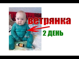 ВЕТРЯНКА. 2 ДЕНЬ. СИМПТОМЫ ВЕТРЯНКИ, ВЕТРЯННОЙ ОСПЫ