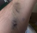 За две недели этот синяк почти не сошёл. Вся надежда на гепариновую мазь